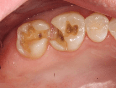 Mercury Fillings Removed Safely