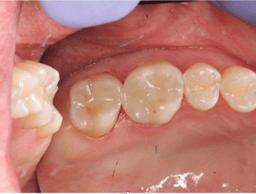 New Natural Composite Fillings